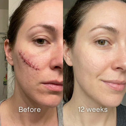 ODALIT™ Silicon ScarStick Limited Time 75%OFF Buy 1 Get 2 Free 🔥LAST DAY⏰