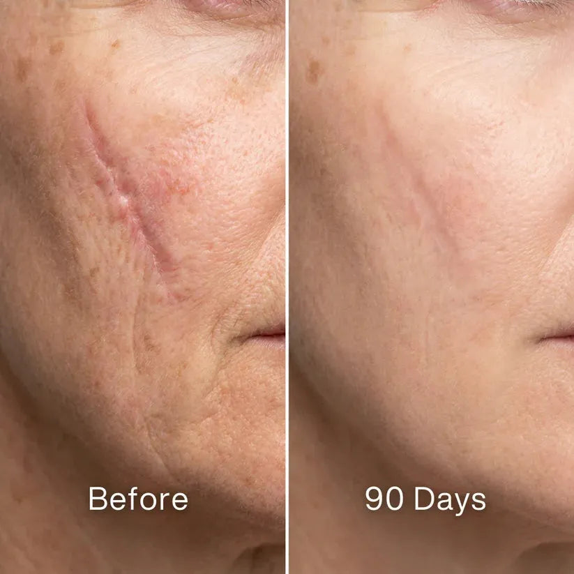 ODALIT™ Silicon ScarStick Limited Time 75%OFF Buy 1 Get 2 Free 🔥LAST DAY⏰