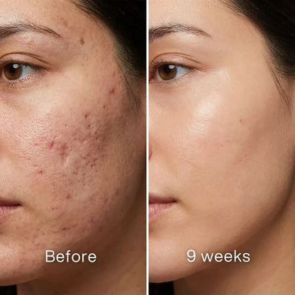 ODALIT™ Silicon ScarStick Limited Time 75%OFF Buy 1 Get 2 Free 🔥LAST DAY⏰