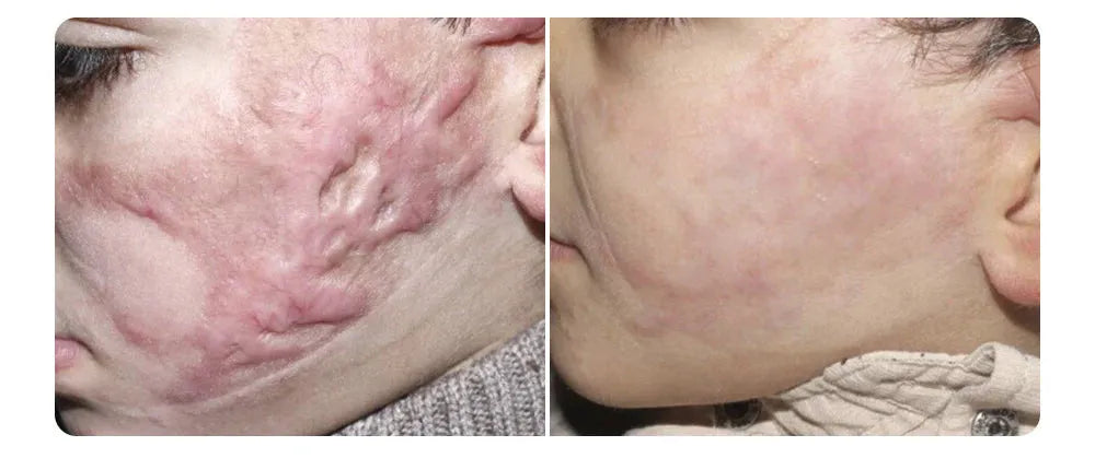 ODALIT™ Silicon ScarStick Limited Time 75%OFF Buy 1 Get 2 Free 🔥LAST DAY⏰