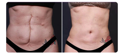 ODALIT™ Silicon ScarStick Limited Time 75%OFF Buy 1 Get 2 Free 🔥LAST DAY⏰