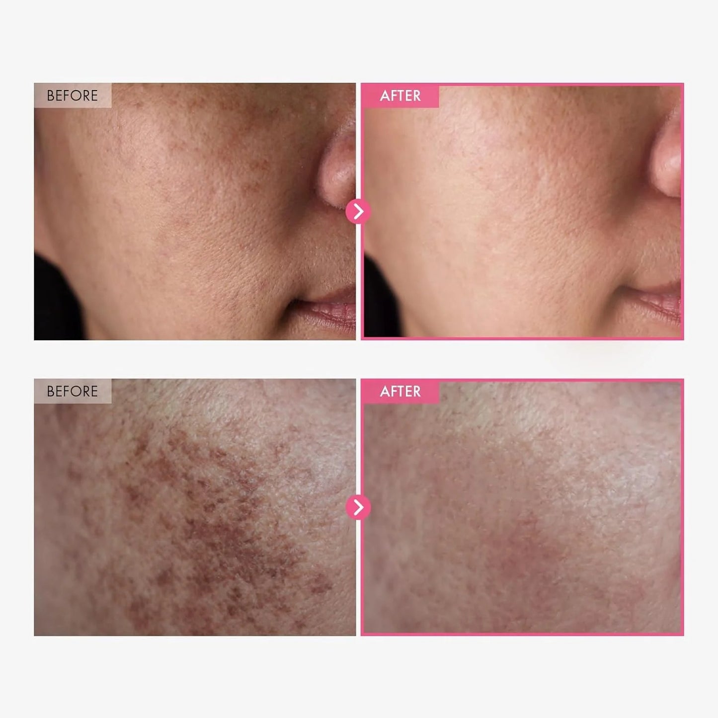 ODALIT™  Arbutin 7% + Tranexamic Acid 4% Cream Limited Time 70%OFF 🔥LAST DAY⏰