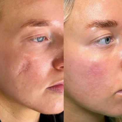 ODALIT™ Silicon ScarStick Limited Time 75%OFF Buy 1 Get 2 Free 🔥LAST DAY⏰